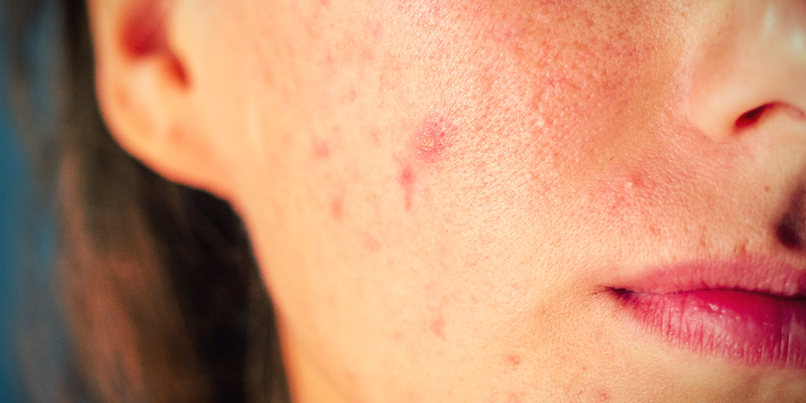 Was tut CBD für die Haut: Es vermindert Hautunreinheiten