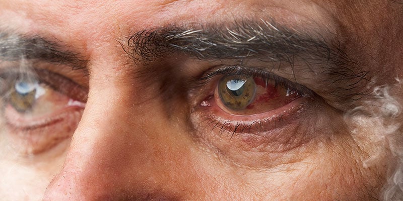 Why does cannabis cause red eyes?